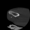 SPORK, NICO - 22.03.1976 - 02.08.2022 - CT obere Extremität - 17:51:17